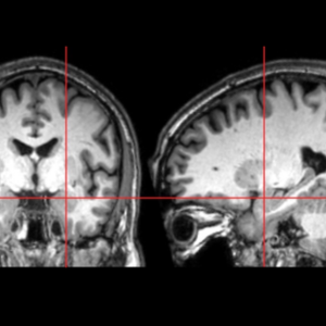 Two brain scan images. Red crosshairs show the location of the amygdala.